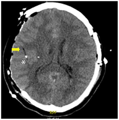 Technical notes on the placement of cerebral microdialysis: A single center experience